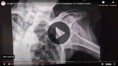 Shoulder dislocation Dr. Esteban Castro Contreras - Traumatologist and Orthopedist